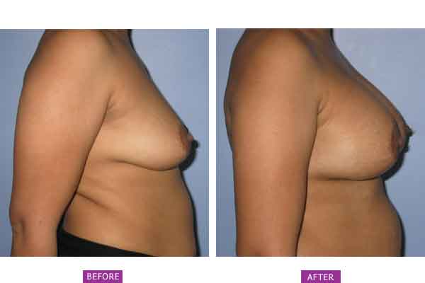 Breast Implant Before & After Photo - Dr. Ashish Davalbhakta