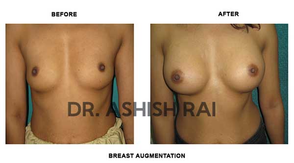 Breast Implant Before & After Photo - Dr. Ashish Rai