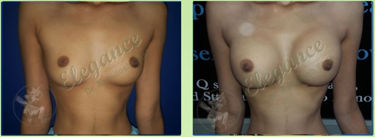 Breast Implant Before & After Photo - Dr. Ashutosh Shah