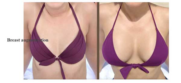 Breast Implant Before & After Photo - Dr. E Kavarthini