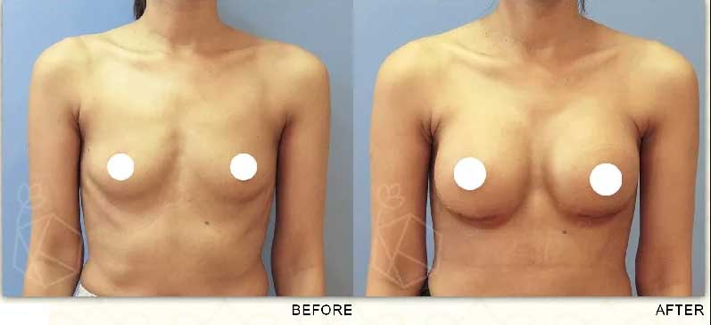 Breast Implant Before & After Photo - Dr. Karishma Kagodu