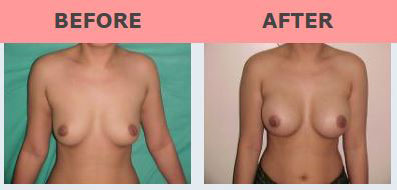Breast Implant Before & After Photo - Dr. Manoj Khanna