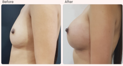 Breast Implant Before & After Photo - Dr. Rajat Gupta
