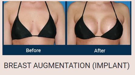 Breast Implant Before & After Photo - Dr. Sumit Jaiswal