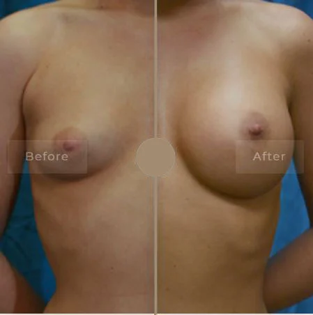 Breast Implant Before & After Photo - Dr. Ujwala Dahiphale