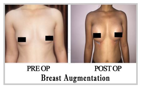Breast Implant Before & After Photo - Dr. Varsha Bundele