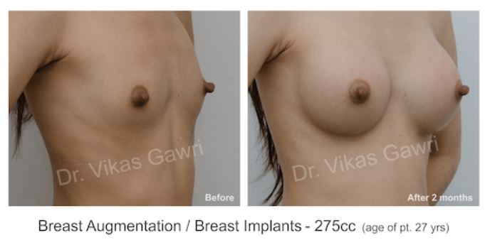 Breast Implant Before & After Photo - Dr. Vikas Gawri