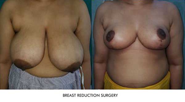 Breast Implant Before & After Photo - Dr. Sumit Malhotra