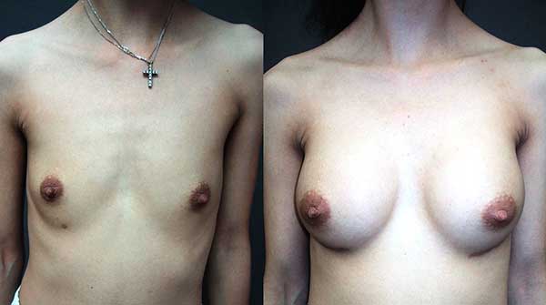 Breast Implant Before & After Photo - Dr. Bhangoo